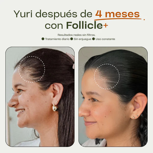 Protocolo Intensivo Anticaída