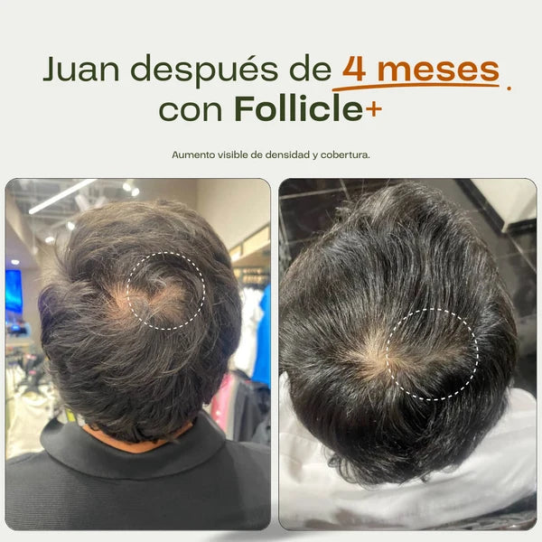 Protocolo Intensivo Anticaída